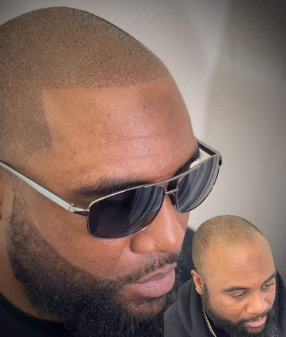 scalp micropigmentation