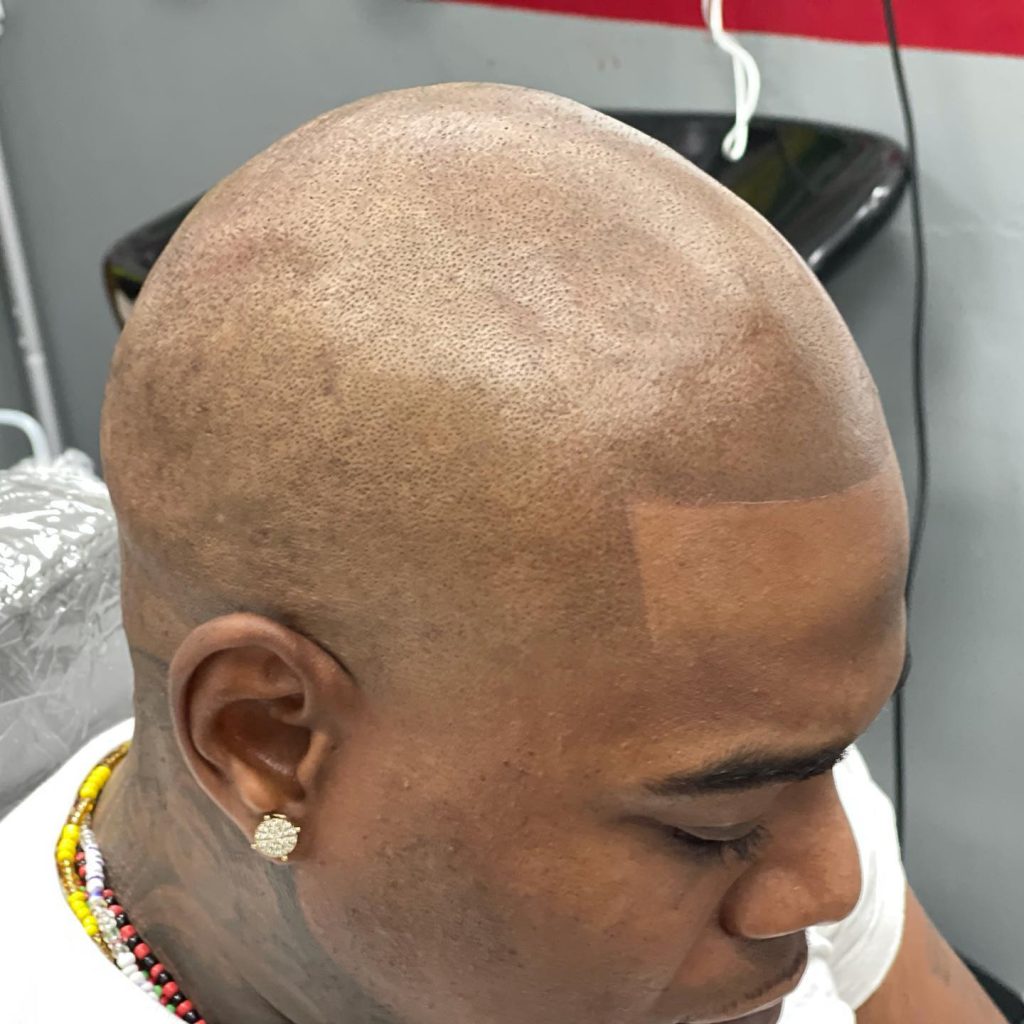 Discover the Art of Scalp Micropigmentation in Atlanta, GA Unveiling