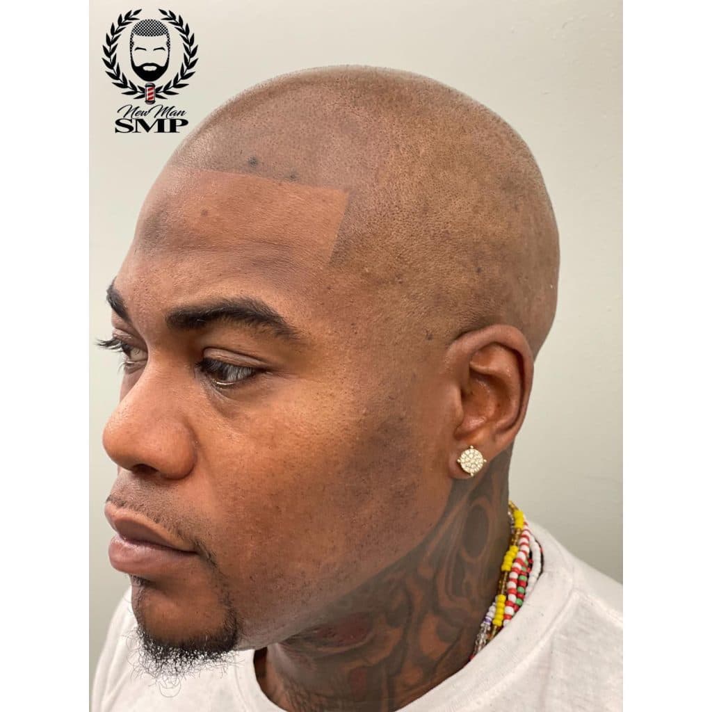 Discover the Ideal Scalp Micropigmentation Hairline in Atlanta, GA