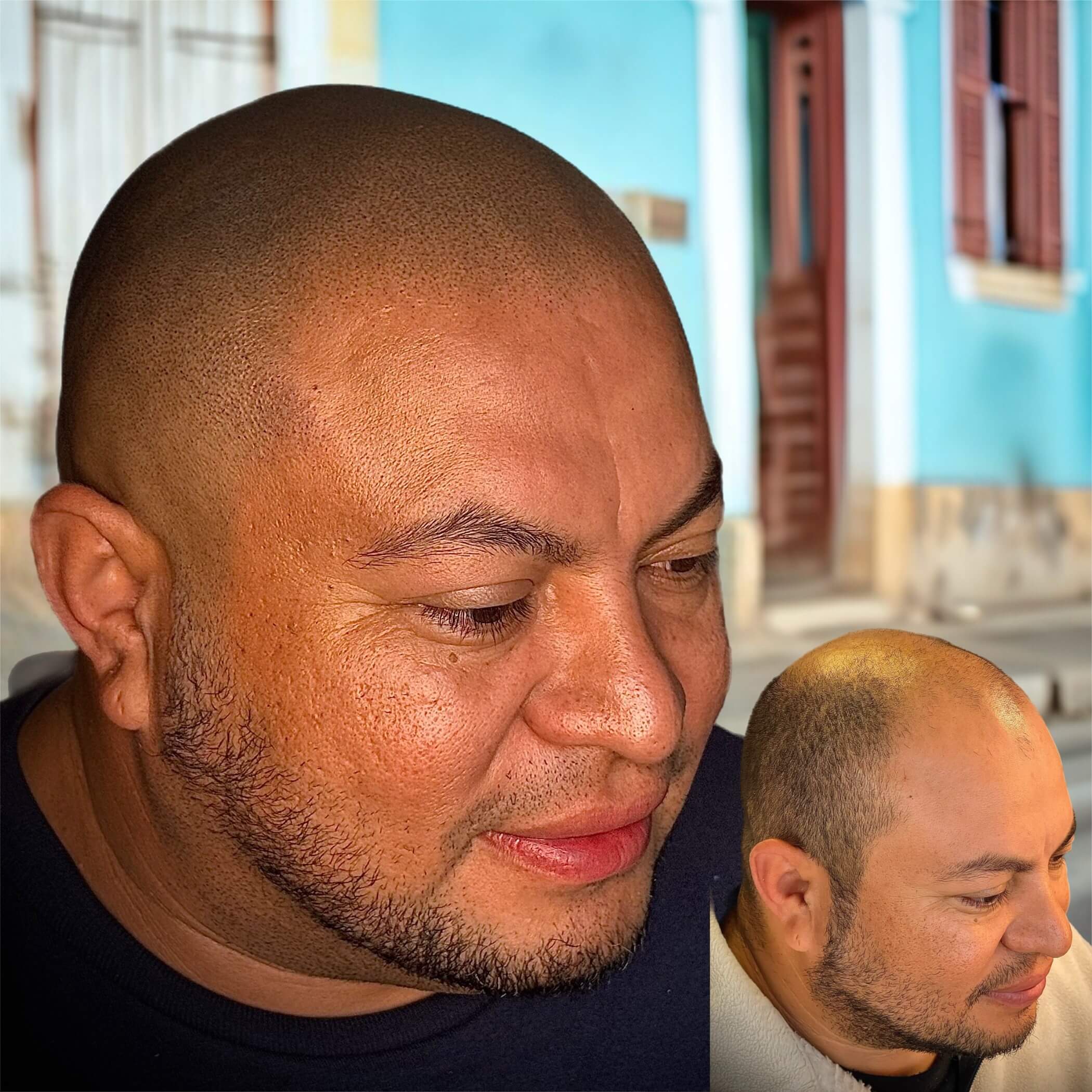 SMP scalp micropigmentation doraville