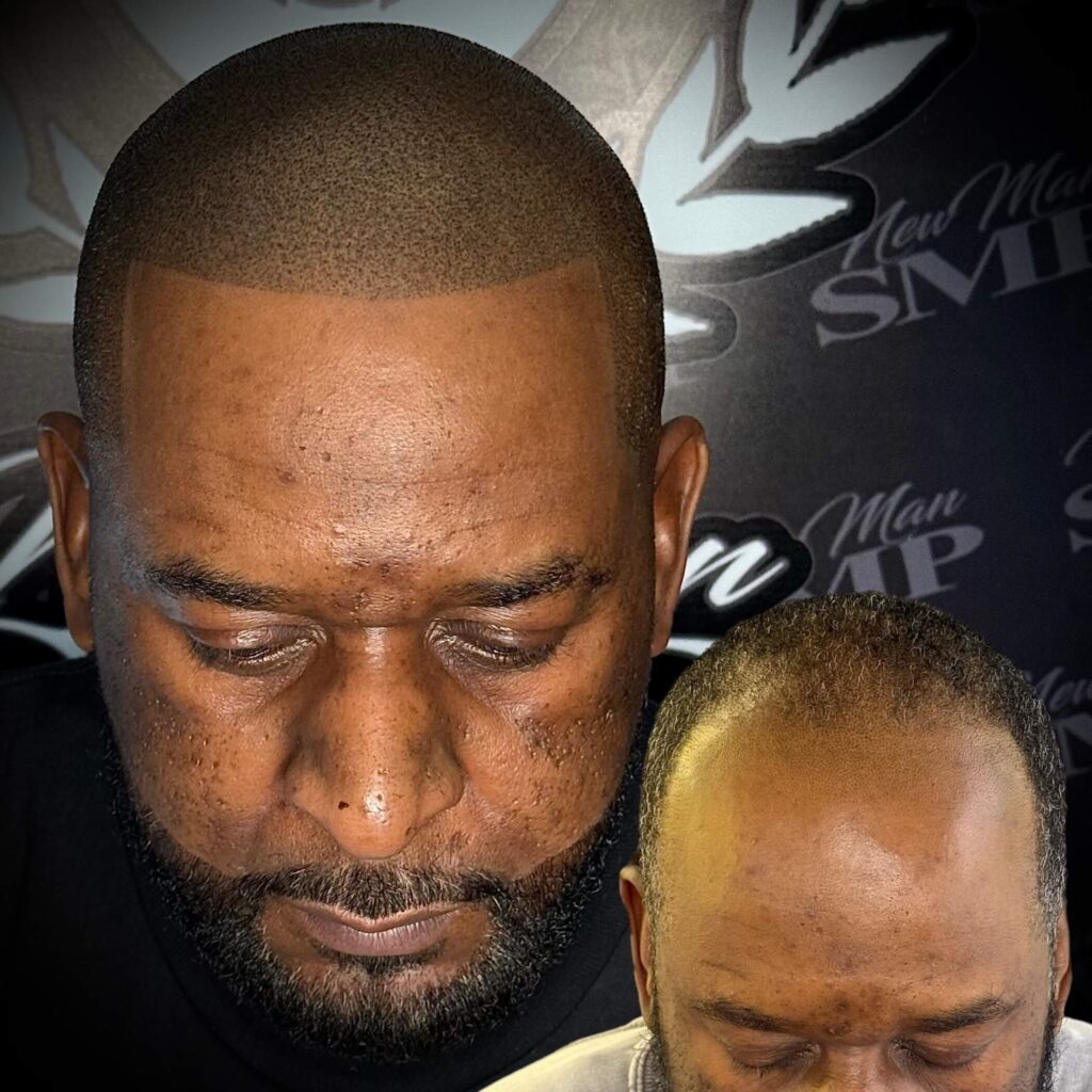alopecia smp doraville client