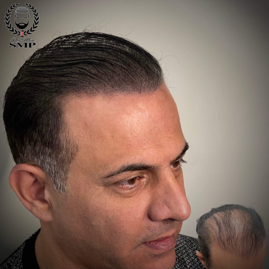hair loss solution doraville client