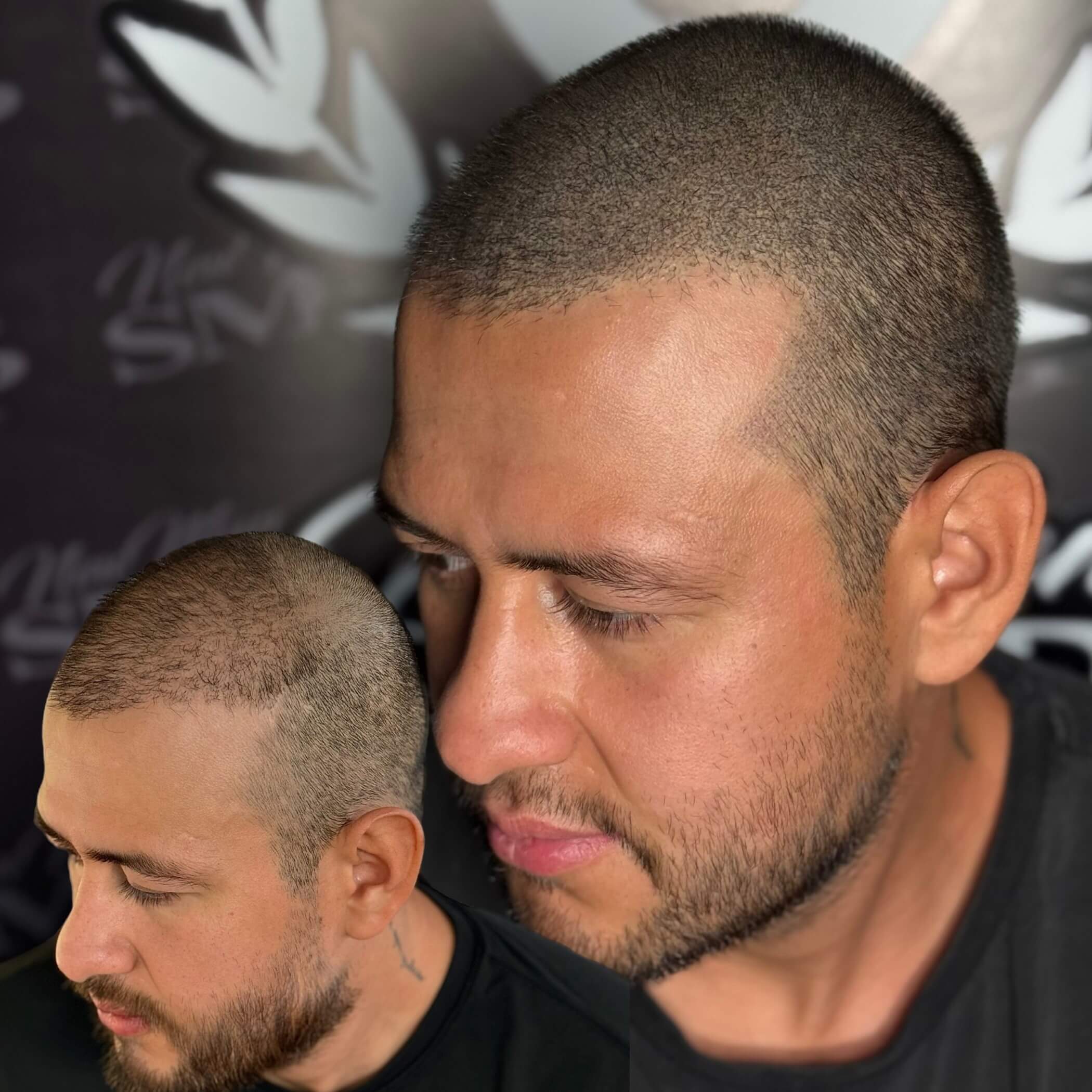 scalp micropigmentation doraville client