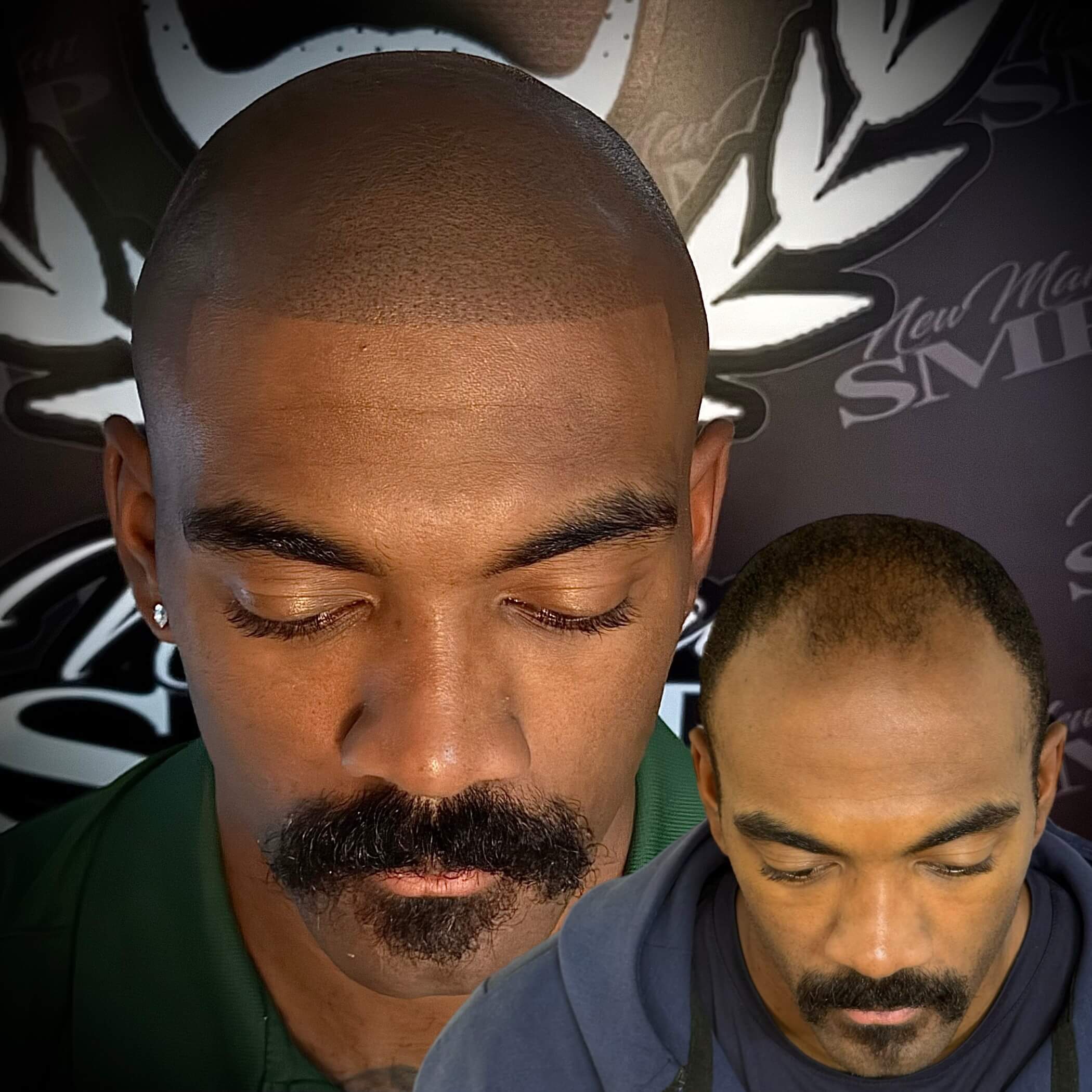 scalp micropigmentation doraville ga client